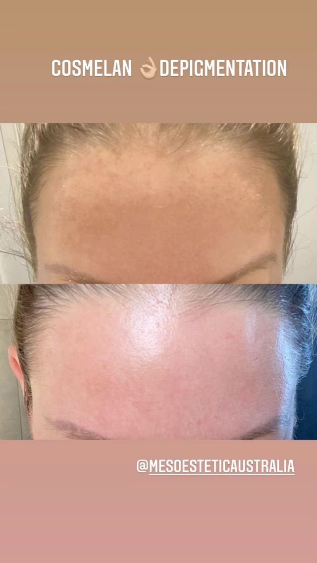 opulence glutathione before and after Opulence Brightening Oxygen Facial